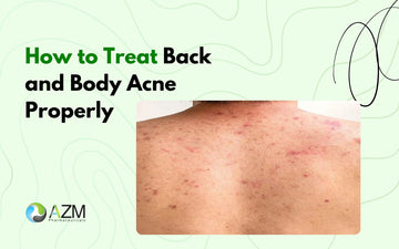 How to Treat Back and Body Acne Properly