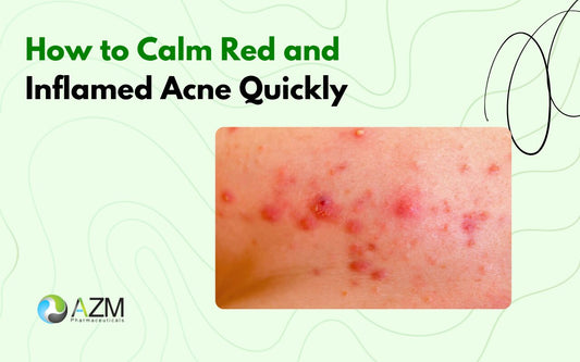 How to Calm Red and Inflamed Acne Quickly