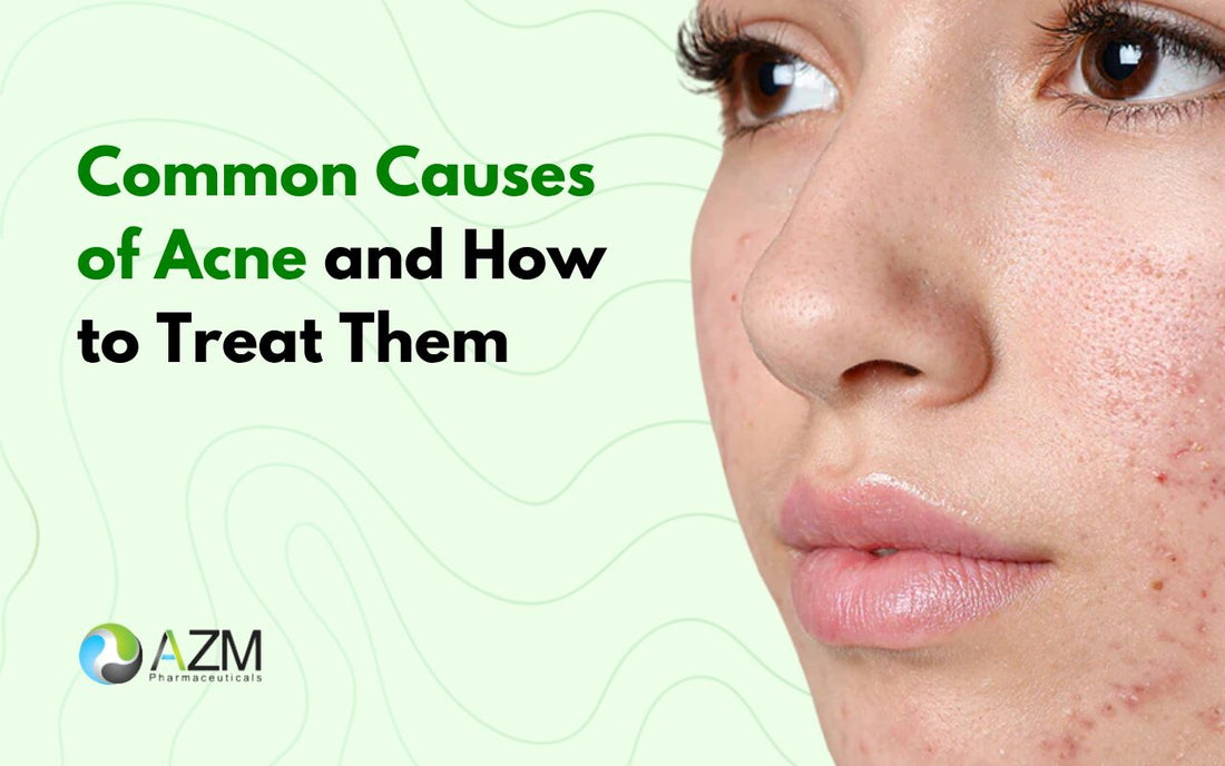 Common Causes of Acne and How to Treat Them
