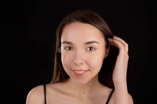 Remove Pimples Naturally and Permanently